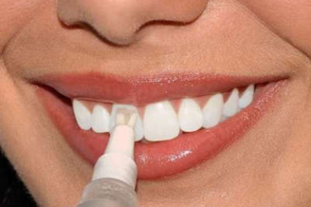 Отбеливание зубов: развеиваем мифы