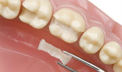 Зубная коронка вкладкой или зубной протез