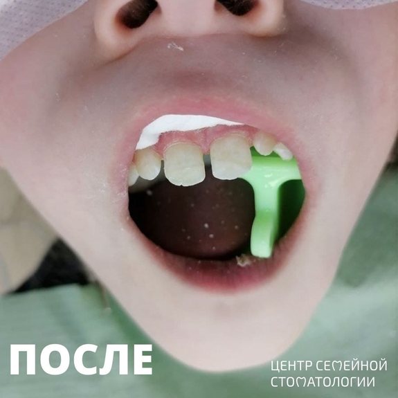 Фото после лечения и реставрации