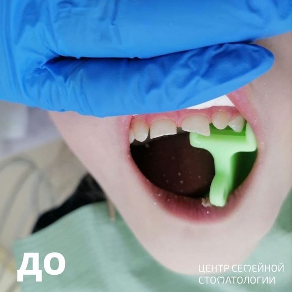 Фото до лечения и реставрации