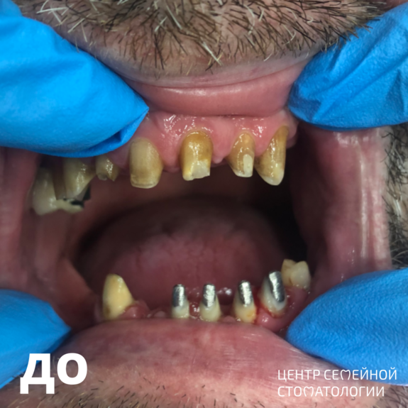 Фото до протезирования