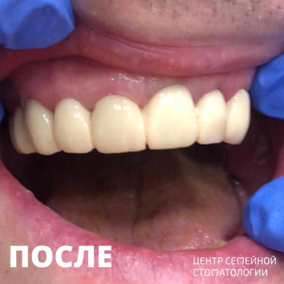 Фото после протезирования