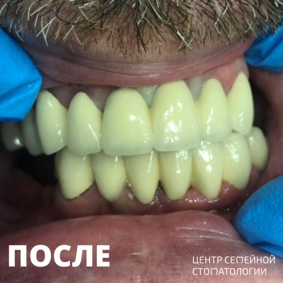 Фото после протезирования