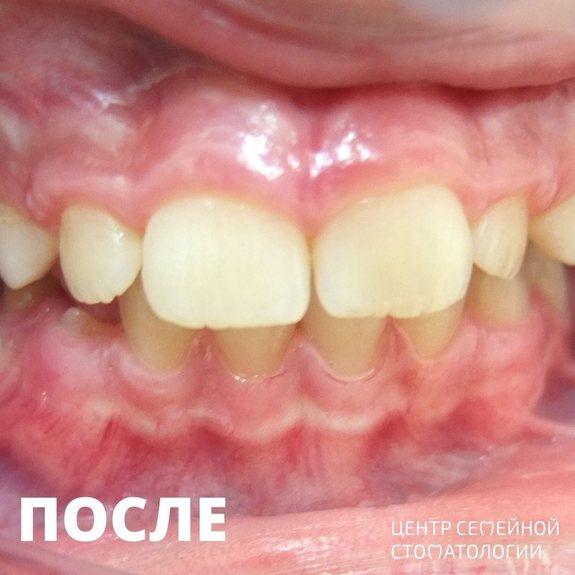 Фотография после лечения
