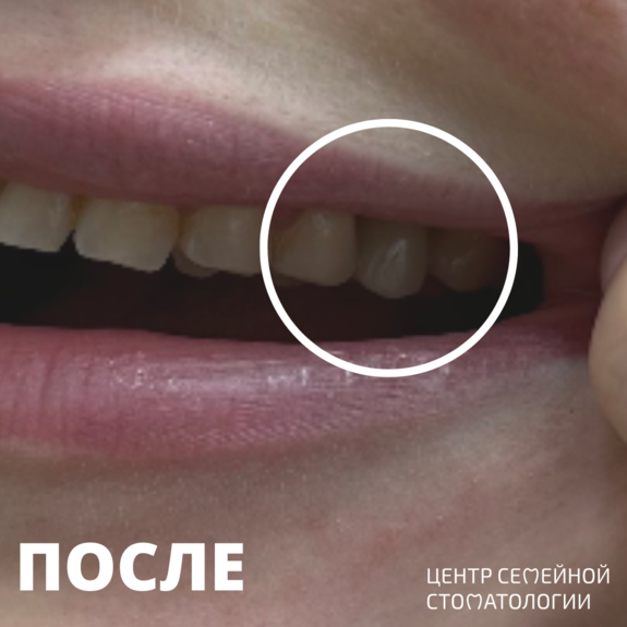 После выравнивания зубов брекетами Damon Q