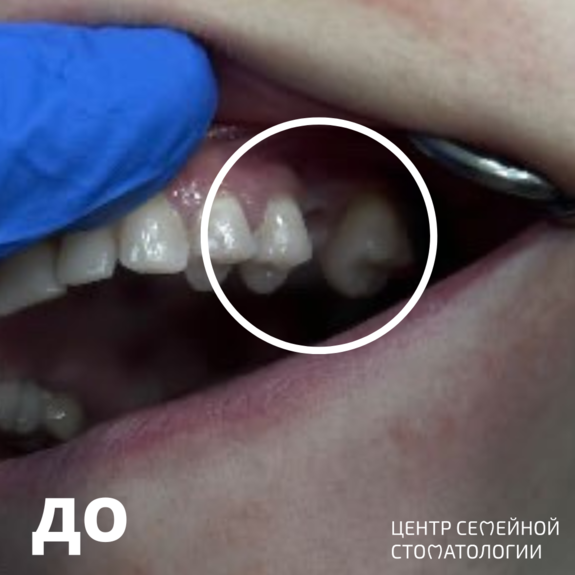 Фотография до установки циркониевой коронки на имплантат