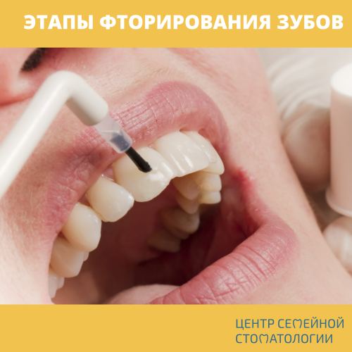Этапы фторирования зубов