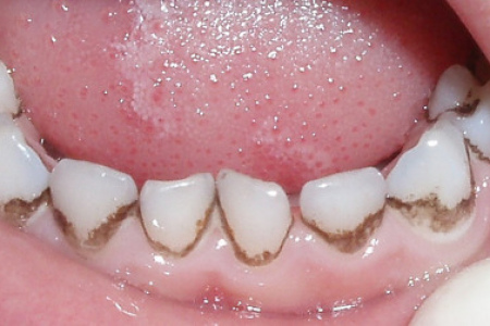 Черный налет на зубах: причины образования и методы удаления