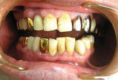 Гальваноз (эффект батарейки во рту): причины, симптомы, лечение