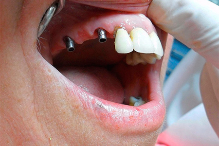 Какие могут быть осложнения после имплантации зубов