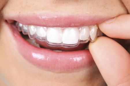 Капы для выравнивания зубов (элайнеры): плюсы, минусы, правила ухода