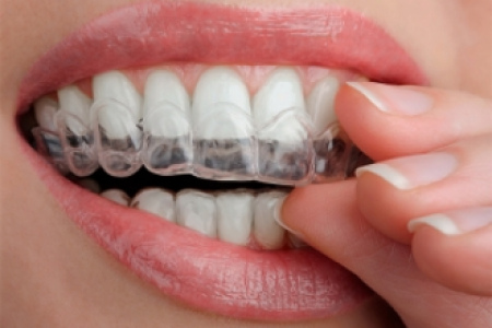 Капы для отбеливания зубов: преимущества, противопоказания, правила использования