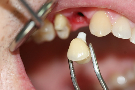 Что происходит, когда мы теряем зубы?