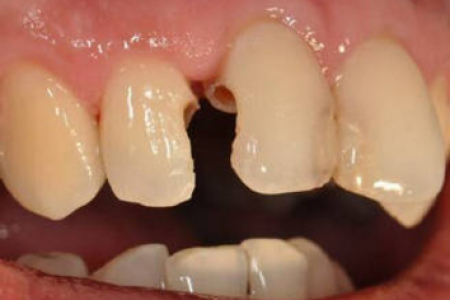 Кариес между зубами: особенности, причины, лечение