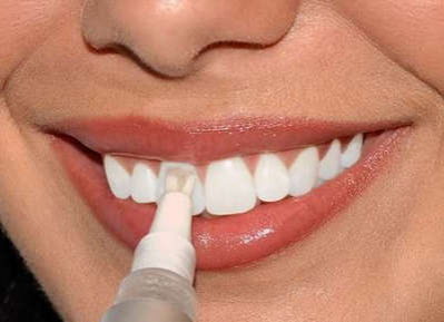 Самые распространенные мифы об отбеливании зубов