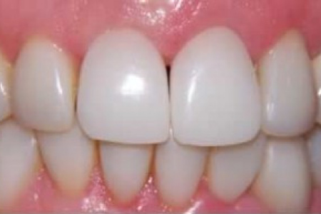 Пластмассовые коронки на зубы: особенности, плюсы, минусы, установка