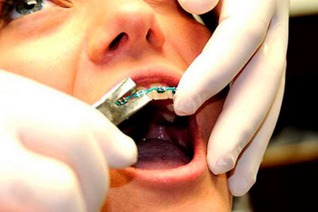 Зубы после брекетов: правила ухода и рекомендации