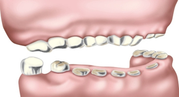 Стираемость зубов – патология или дефект?