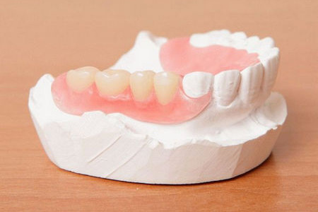 Плюсы и минусы протезирования зубов