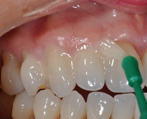 Реминерализация зубов: показания к применению