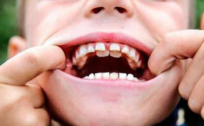 Что такое сверхкомплектные зубы или гипердонтия, причины, лечение