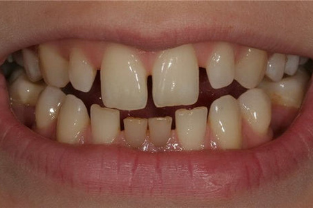 Тремы зубов: особенности, причины развития, лечение