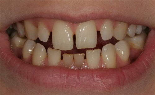 Что такое тремы между зубами, почему появляются, как лечатся