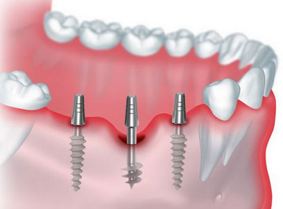 Удаление имплантата зуба. Когда это необходимо?