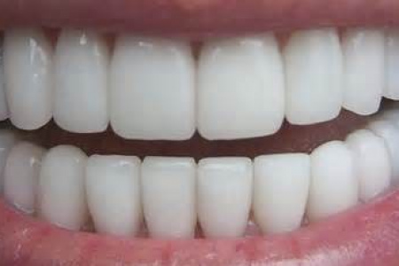 Основные виды отбеливания зубов: плюсы и минусы