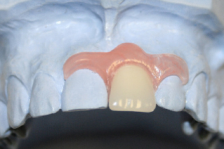 Временный зубной протез: особенности, разновидности, показания к применению, установка и уход