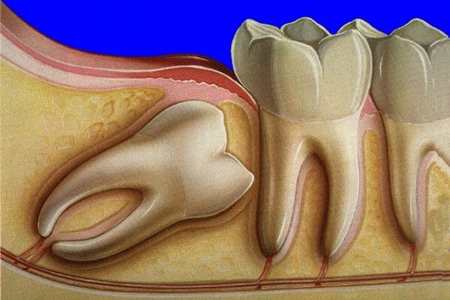 Показания и особенности лечения и удаления зубов мудрости под наркозом (седацией)