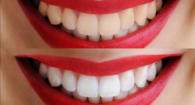 Ламинирование зубов: плюсы и минусы