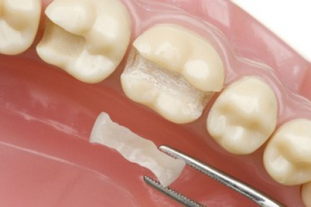 Зубная коронка вкладкой или зубной протез, подробнее о нем