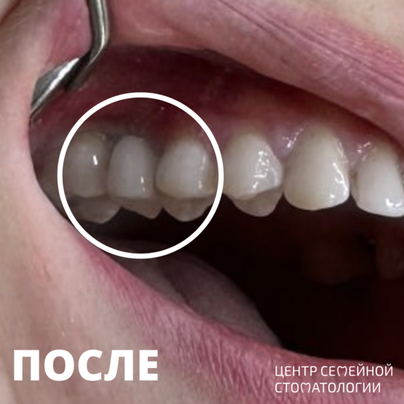 После выравнивания зубов брекетами Damon Q