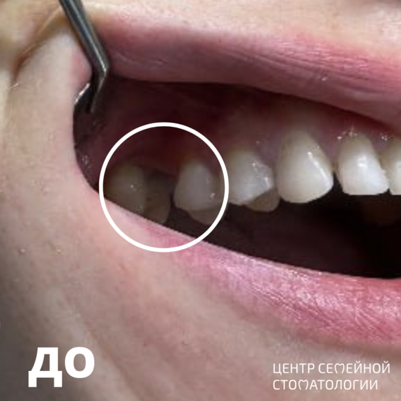 Фотография до установки циркониевой коронки на имплантат