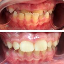 Ортодонтическое лечение зубов девочке 8 лет с фото до и после