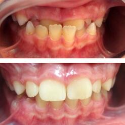 Ортодонтическое лечение зубов девочке 8 лет с фото до и после