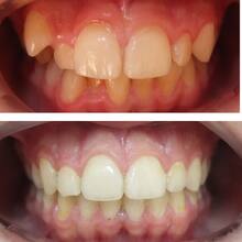 Ортодонтическое лечение зубов мальчику 13 лет с фото до и после