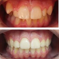 Ортодонтическое лечение зубов мальчику 13 лет с фото до и после