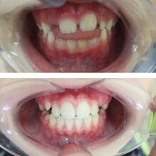 Ортодонтическое лечение зубов девочке 7 лет с фото до и после