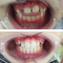 Ортодонтическое лечение зубов девочке 7 лет с фото до и после