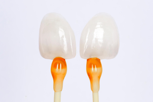 Что такое керамические виниры?