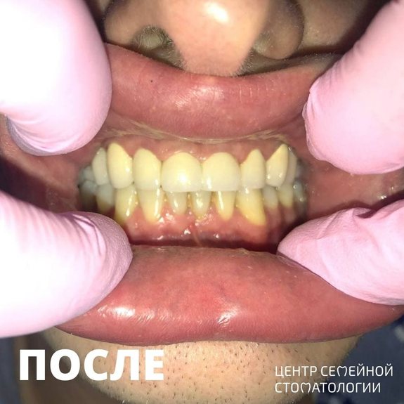 Фотография после протезирования