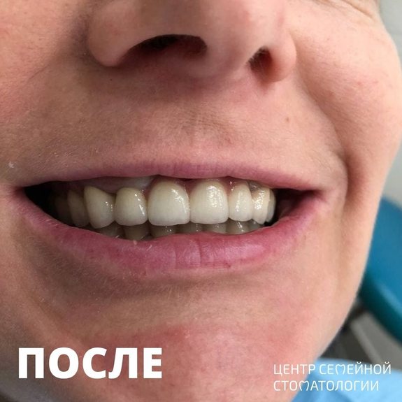 После выравнивания зубов брекетами Damon Q