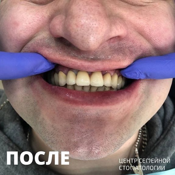 После выравнивания зубов трейнерами