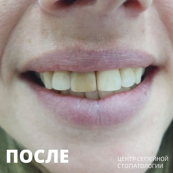 Фотография после лечения кариеса