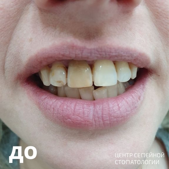 Фотография до лечения кариеса