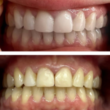 Замена старых пломб на композитные виниры