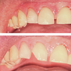 Реставрация зубов взрослому с помощью композитных материалов, фото до и после