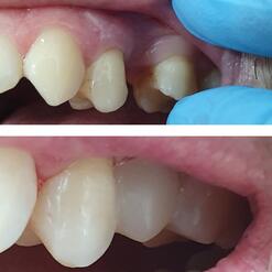Адгезивное протезирование в рамках терапевтического лечения, фото до и после